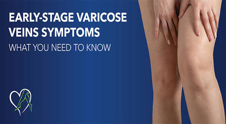 Attention! Leg Discomfort May Be an Early Sign of Varicose Veins