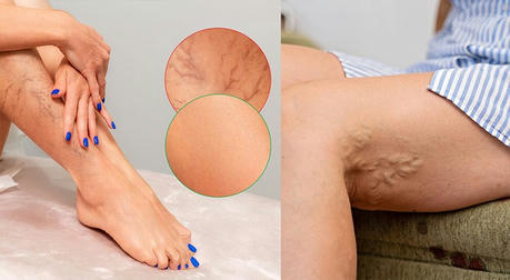 How to Detect and Treat Varicose Veins Early?