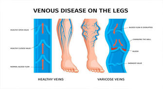 Understanding Varicose Veins