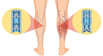 How to relieve varicose vein symptoms through diet conditioning?