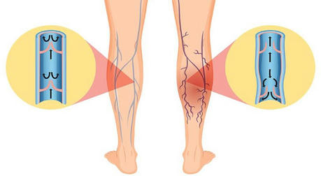 How to relieve varicose vein symptoms through diet conditioning?